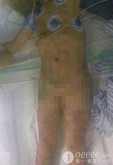残忍!<em>5岁女童</em>被虐遍体鳞伤 生命垂危