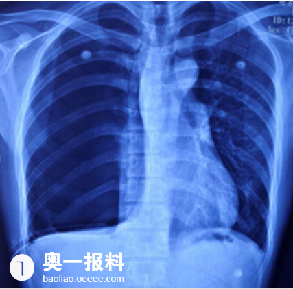 深圳小伙右肺突然不见 左肺差点也没了_报料_