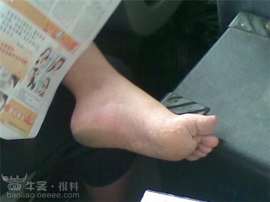 臭脚是有什么原因