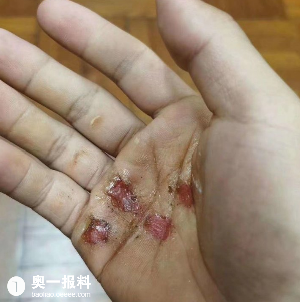 防疫工作者手掌溃烂辛苦你们了