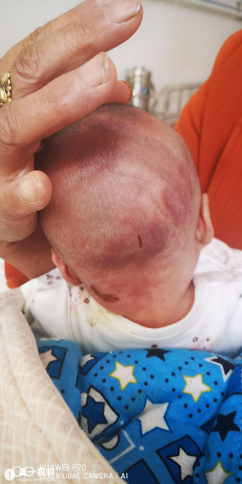 新生儿严重缺氧